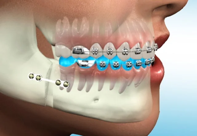 Ortognatik Cerrahi (Çene Cerrahisi)